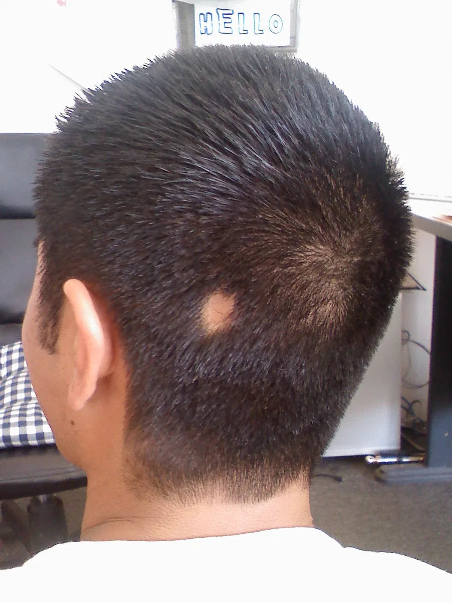 Alopecia Areata: Causes, Treatment Options, and Recovery