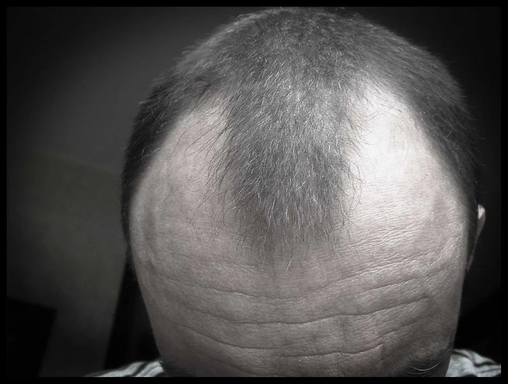 The 15 Biggest Hair Loss Myths - And the Scientific Truth