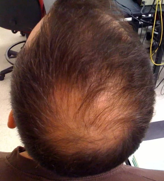 Hims vs Regrowthy: Two Very Different Approaches to Hair Loss