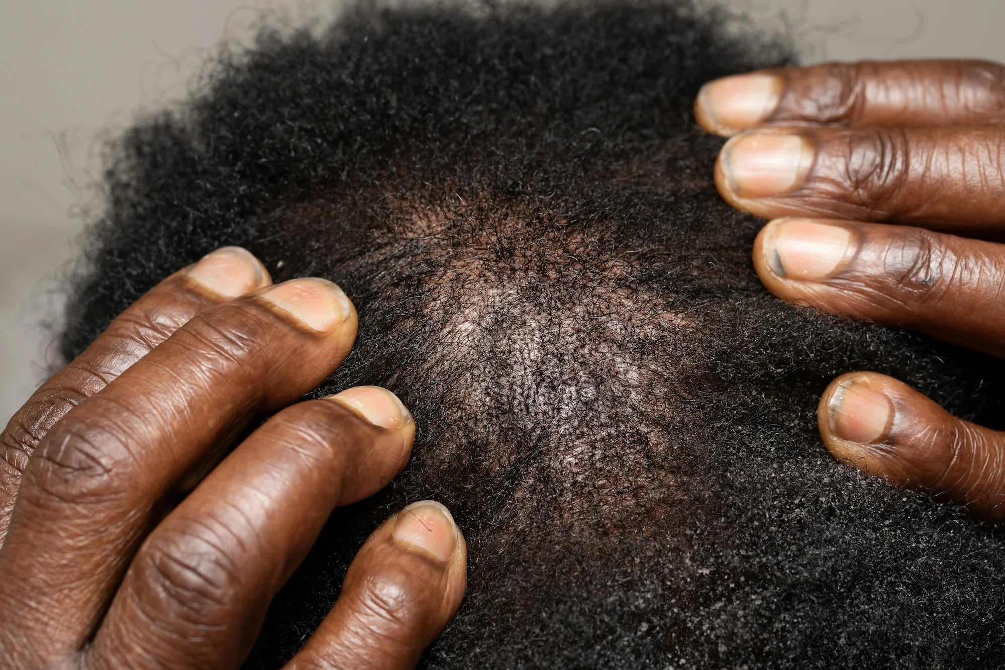 Close-up of hands parting hair to examine a scalp, checking for flaking, dryness, and hair loss on the skin