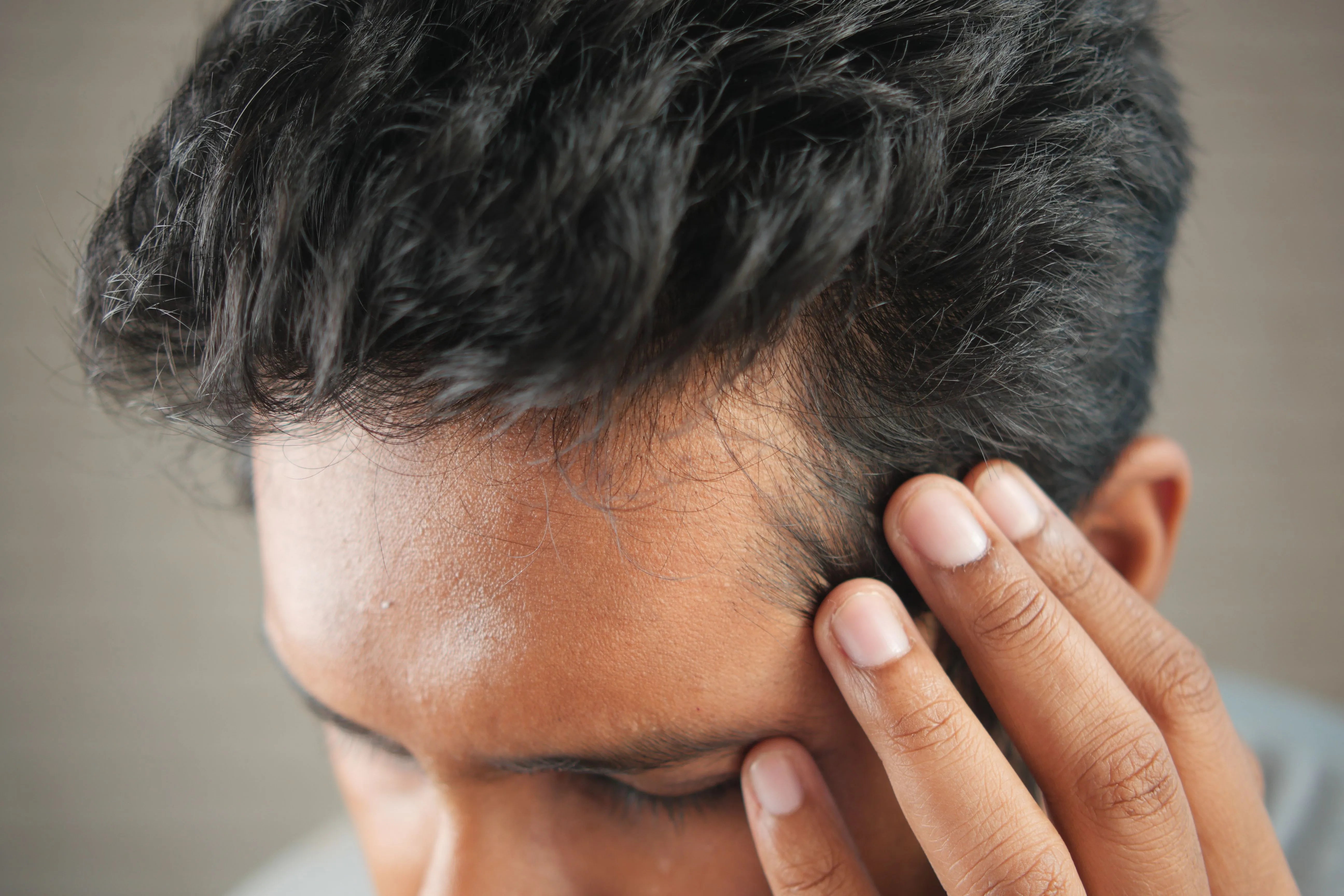 Preventing Hair Loss in Your 20s: The Early Action Advantage