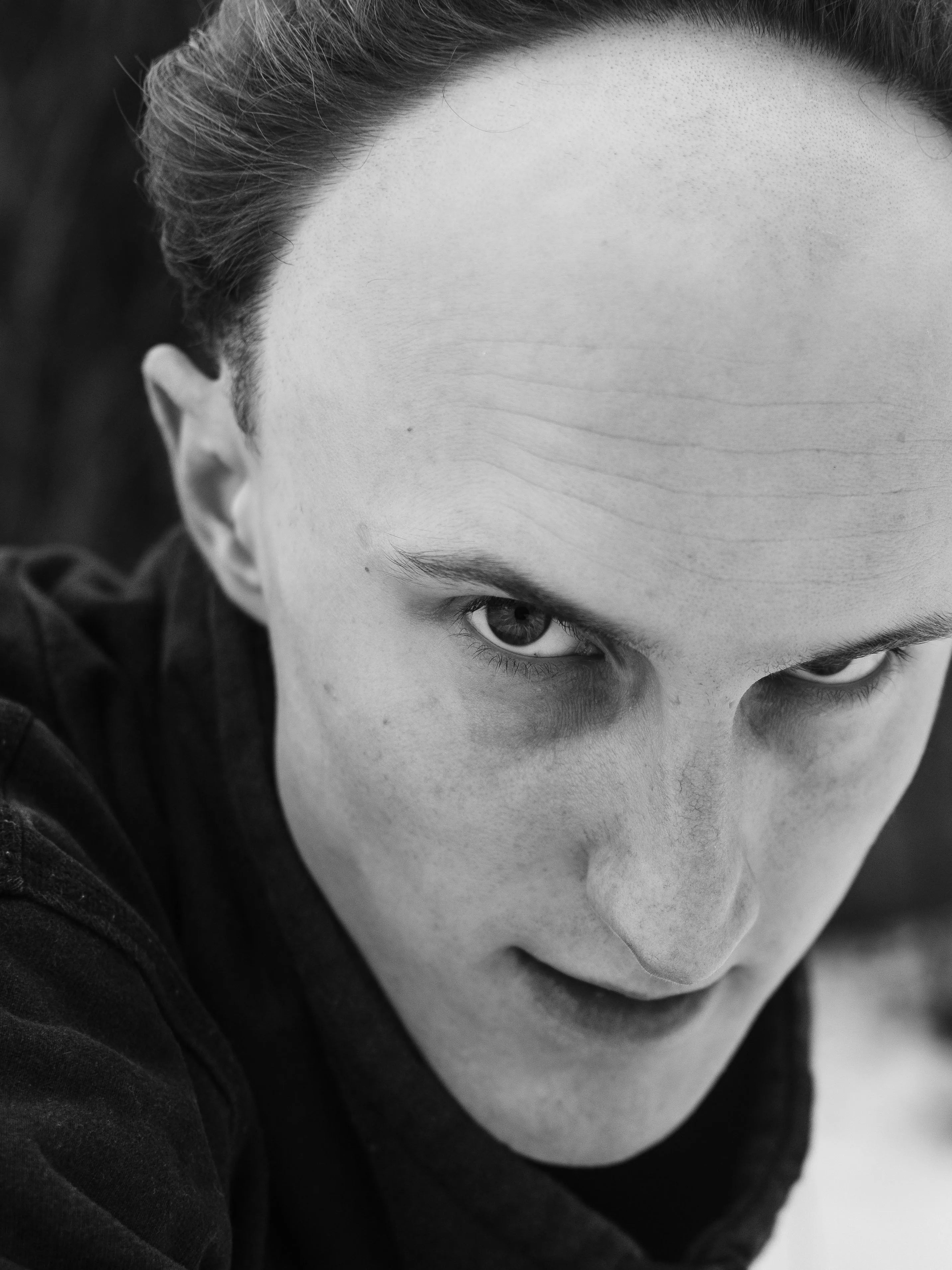 Receding Hairline: Stages, Causes, and How to Stop It