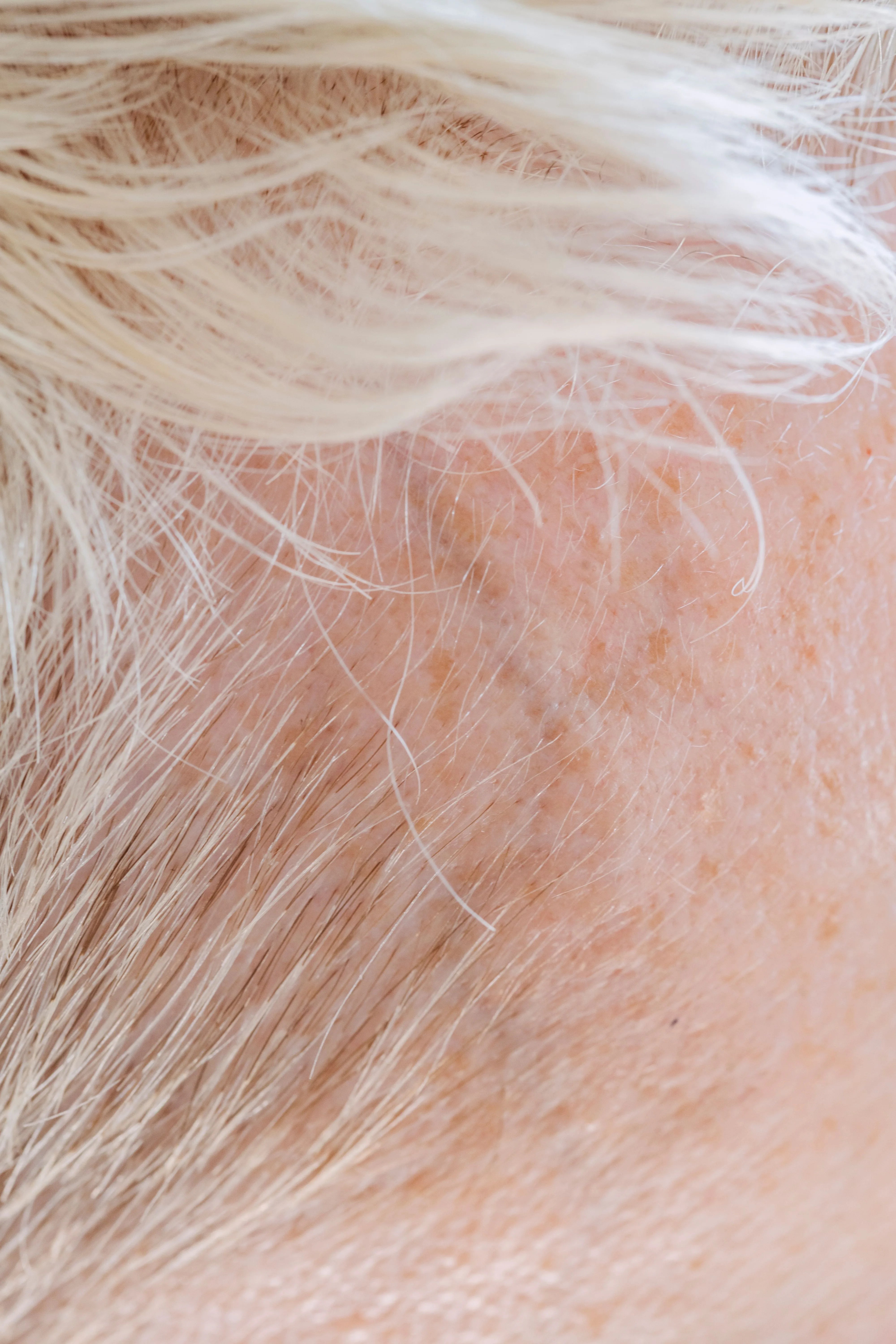Scarring Alopecia: When Hair Loss Becomes Permanent