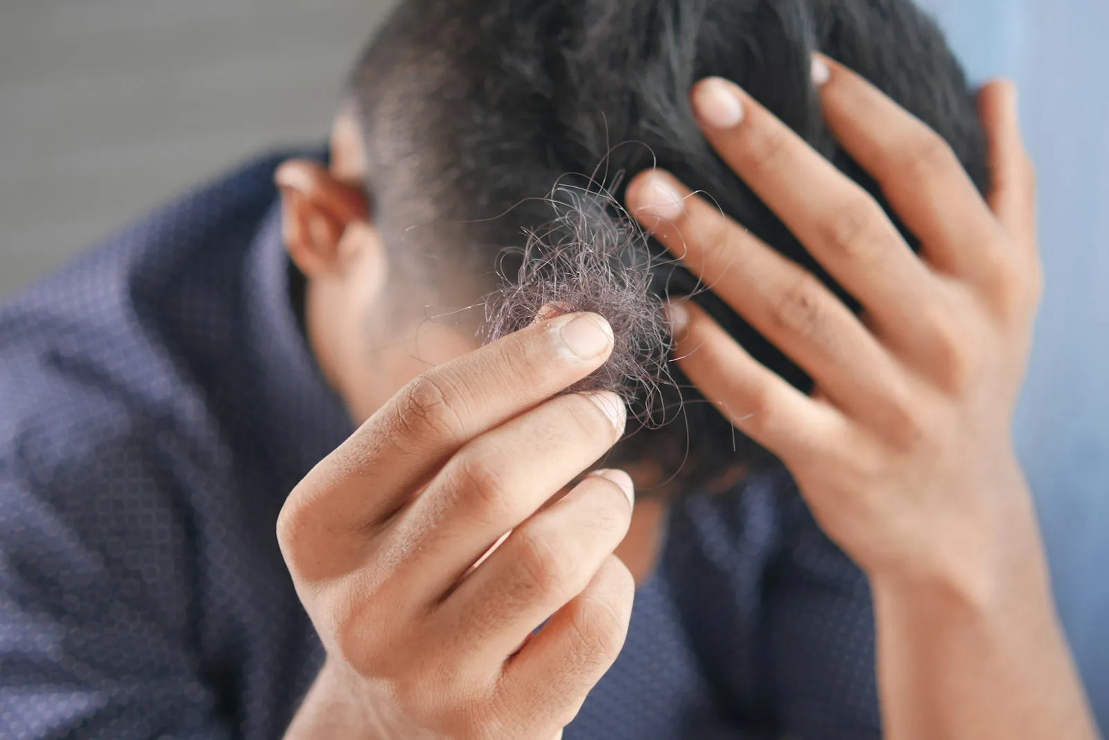 Does High Testosterone Cause Hair Loss? The Real Relationship